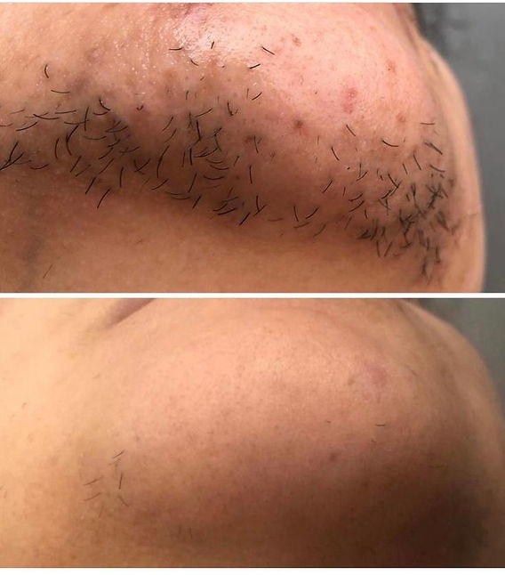 Facial laser hair removal before and after result