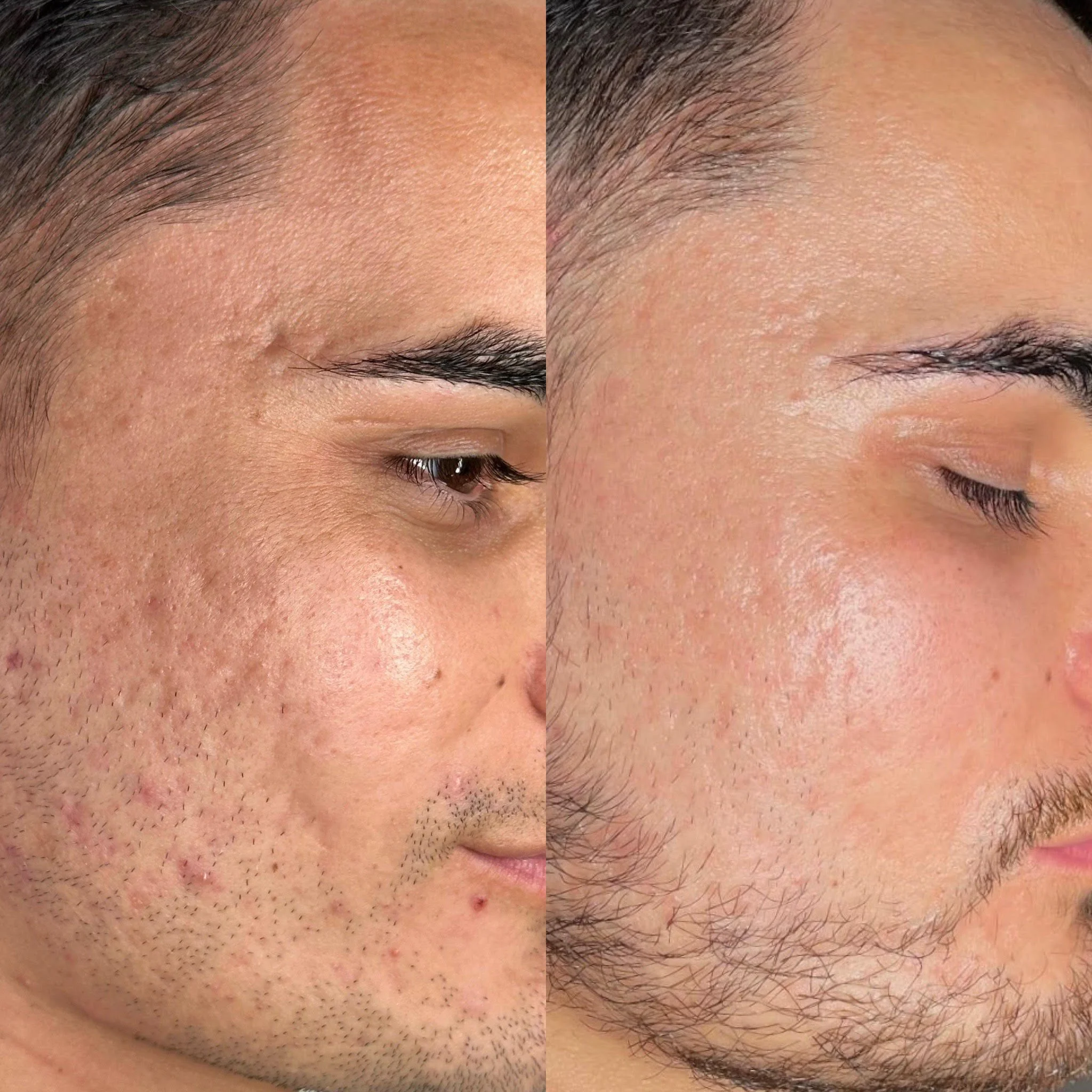 Subcision and PRP before and after result