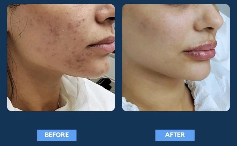 Microneedling and PRP before and after result