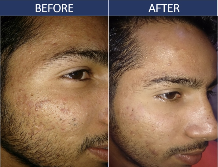 PRP mesotherapy before and after result